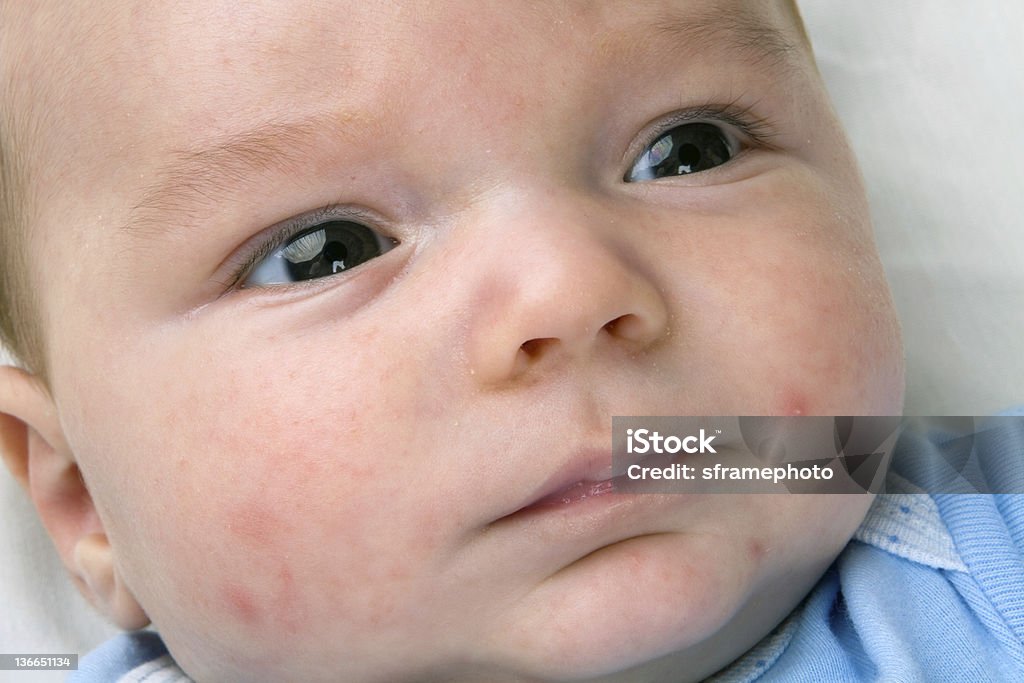 Baby Acne On Newborn Close up of newborn baby's face with red rash acne and pimples common known as baby acne. Baby - Human Age Stock Photo