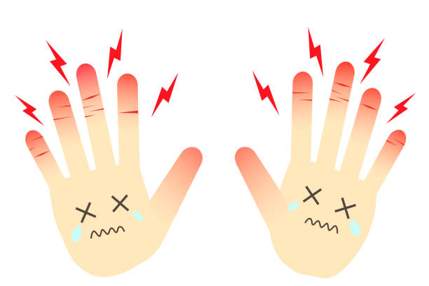 rhagades, czerwone i opuchnięte ręce.
koncepcja szorstkich rąk. - adult allergy casual white background stock illustrations