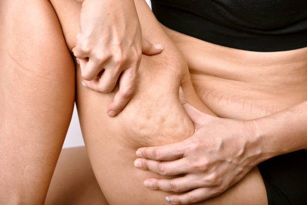 Cellulite mark problem on leg, Fat woman with excessive belly pinching thigh skin, Overweight body test. stock photo