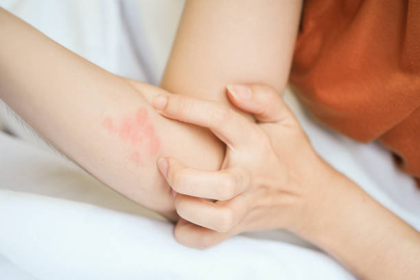 The woman had an itchy red rash on her arm, so she scratched from an insect bite. The woman had an itchy red rash on her arm, so she scratched from an insect bite. bug bite stock pictures, royalty-free photos & images