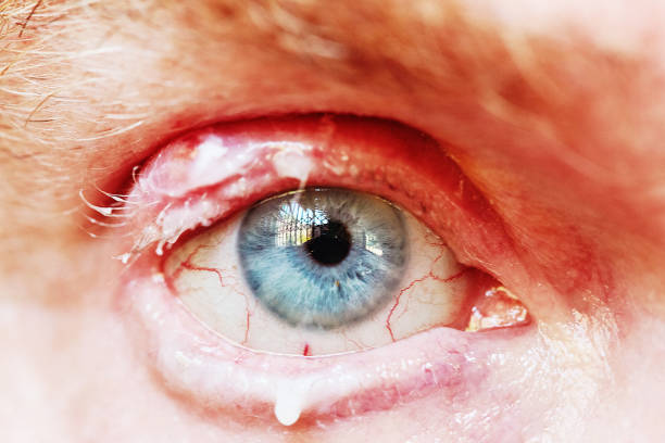 남자의 눈에 불쾌한 stye : 염증 상부 눈꺼풀 빨간색과 감염으로 부어, 눈 연고로 덮여 - pain human eye senior adult men 뉴스 사진 이미지