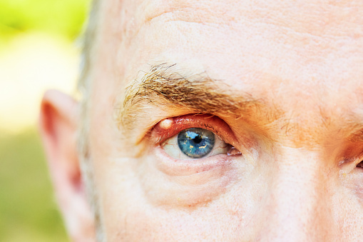 Blue-eyed mature man with an infected upper eyelid.