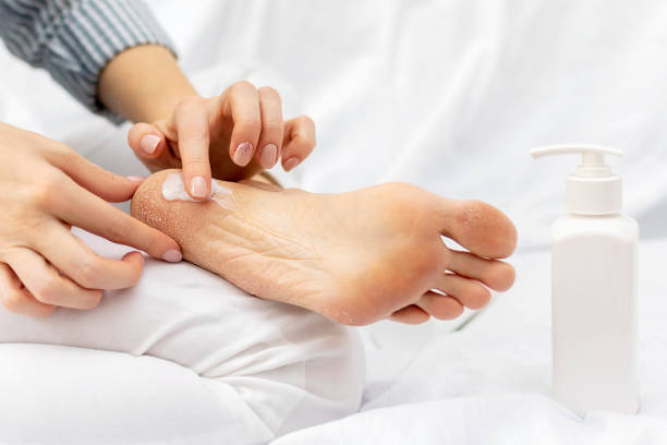 Hand of a woman applies a moisturizing nourishing cream to the heels of feet with dry cracked skin while sitting on a white bed. Home foot care and treatment for dermatitis, dryness. Womans hand applies moisturizing nourishing cream to the heels of feet with dry cracked skin while sitting on a white bed. Home foot care and treatment for dermatitis, eczema, dryness. human foot stock pictures, royalty-free photos & images