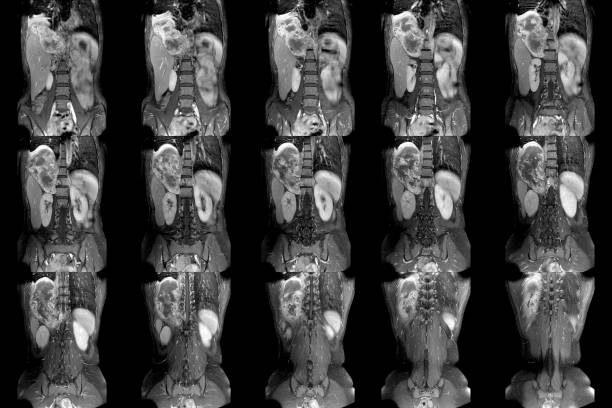istock MRI OF THE THORACOLUMBAR SPINE 1366603777
