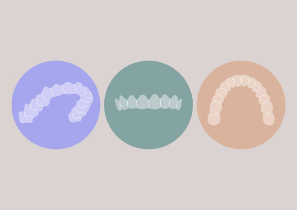 stockillustraties, clipart, cartoons en iconen met a set of plastic removable dental aligners, invisible braces technology, teeth straightening, whitening, and grinding protection - orthodontist illustraties