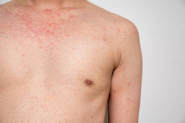 피부염 발진 바이러스 성 질병 면역 결핍 젊은 성인 아시아의 몸에, 가려움증으로 스크래치 - immunodeficiency 뉴스 사진 이미지