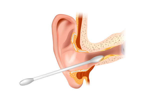 ilustrações de stock, clip art, desenhos animados e ícones de iillustration of the ear canal being cleaned with a cotton swab. section of the ear with the cerumen. removing earwax and wrong way of using cotton swab. - eustachian tube