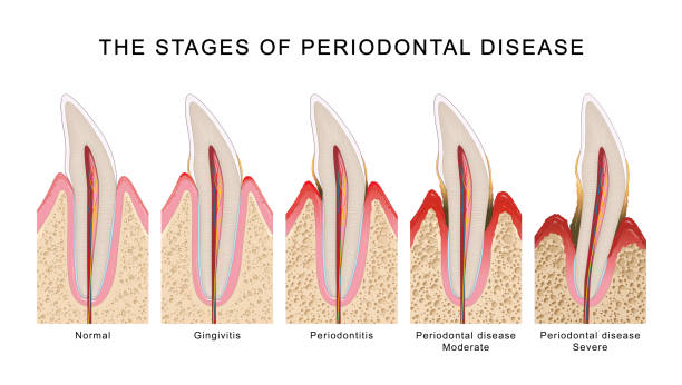 ilustrações de stock, clip art, desenhos animados e ícones de the stages of periodontal disease - canino dente