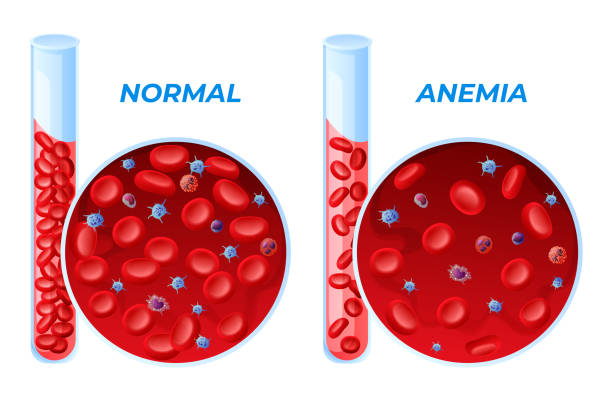 ilustrações de stock, clip art, desenhos animados e ícones de iron deficiency anemia and normal set vector illustration difference of amount of red blood cell - microscope science healthcare and medicine isolated