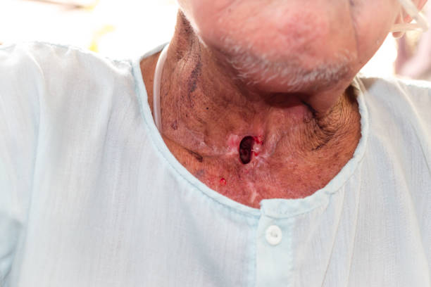 Carcinoma of Larynx and hypopharynx Patients with Laryngeal cancer and Hypopharyngeal cancer pyloric sphincter stock pictures, royalty-free photos & images