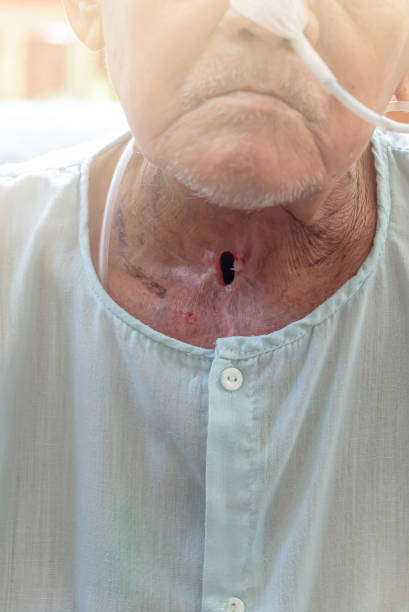 Carcinoma of Larynx and hypopharynx Patients with Laryngeal cancer and Hypopharyngeal cancer larynx stock pictures, royalty-free photos & images