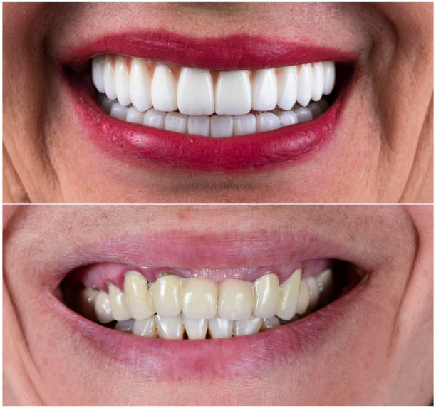 full mouth rehabilitation by crowns veneers and implantsfull mouth rehabilitation by crowns veneers and implants full mouth rehabilitation by crowns veneers and implantsfull mouth rehabilitation by crowns veneers and implants dental crown stock pictures, royalty-free photos & images