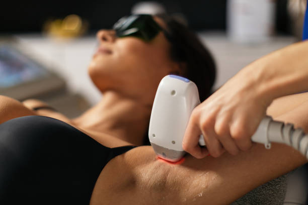 tratamiento de depilación láser. depilación corporal - depilación fotografías e imágenes de stock