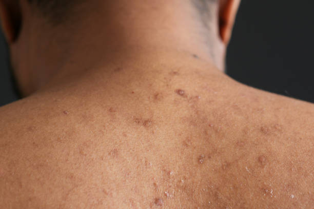 istock close up of young man suffering skin problem . 1366993750