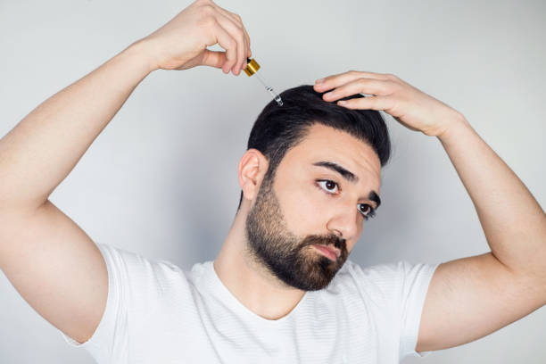 Man baldness treatment. Nature hair care procedure. Oil drop at scalp. Male person applying dermatology lotion. Home routine. trichologist cosmetic product. Anti hairloss clinic mask tratamiento de la calvicie del hombre. procedimiento de cuidado del cabello de la naturaleza. gota de aceite en el cuero cabelludo. persona masculina que aplica loción dermatológica. rutina en casa. producto cosmético tricólogo. máscara clínica anti