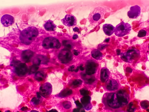 микрофотография метастатической аденокарциномы легкого. плевральная жидкость fnac. 2109 - cancer cell cell cancer human cell стоковые фото и изображения