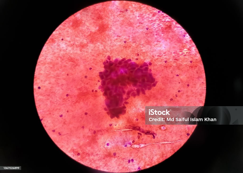 Metastatic adenocarcinoma of lung. Pleural fluid cytology of lung papillary adenocarcinoma, a type of non small cell carcinoma. Lung Cancer Stock Photo