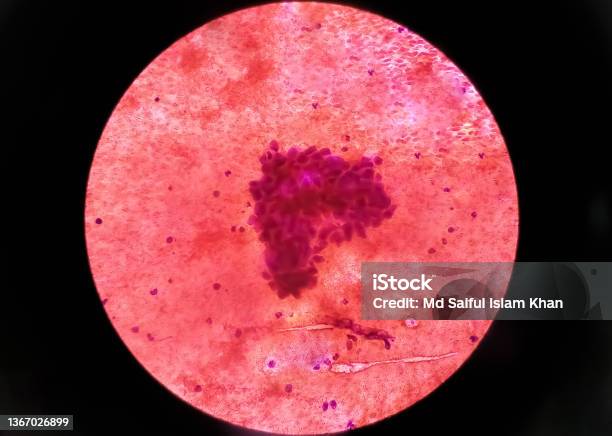 Metastatic Adenocarcinoma Of Lung Pleural Fluid Cytology Of Lung Papillary Adenocarcinoma A Type Of Non Small Cell Carcinoma Stock Photo - Download Image Now
