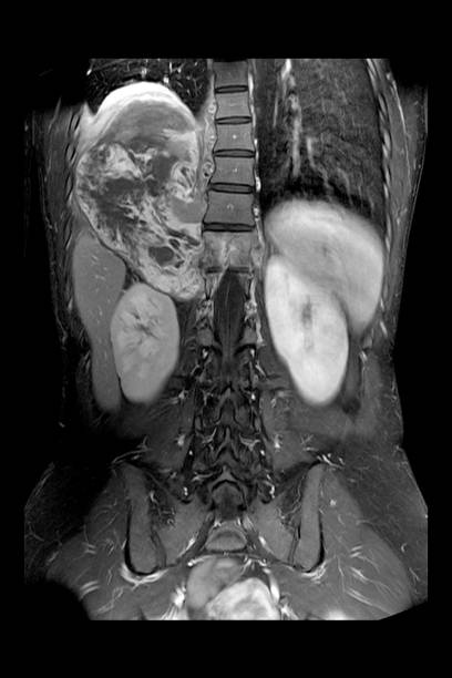 MRI Whole Abdomen. paravertebral mass with central cystic necrosis at Rt lower thorax. MRI Whole Abdomen. paravertebral mass with central cystic necrosis at Rt lower thorax. abdominal cavity stock pictures, royalty-free photos & images