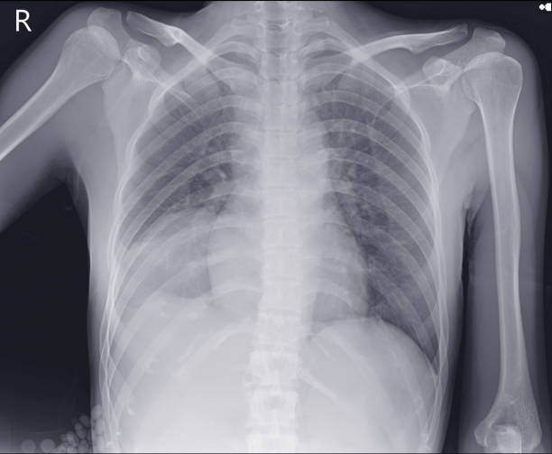 istock Chest x-ray  Rt,lower lung field likely loculateraled pleural effusion 1367098667