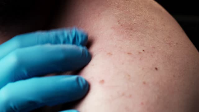 Problème de peau, zona. Une main gantée sent la peau affectée. Soins de la  peau, dermatologie. Clip Vidéo 1367167021
