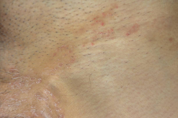 istock Ring Worm infection on skin, Itching in the groin 1367172866
