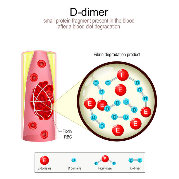 D-dimer formation. Blood vessel with blood clot. vector art illustration