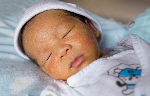 yellow skin colored neonatal jaundice happen in new born baby infant