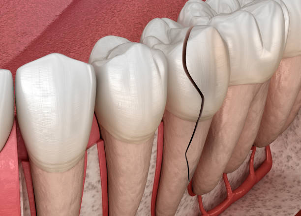istock Cracked tooth, splitted. Medically accurate 3D illustration 1367325927