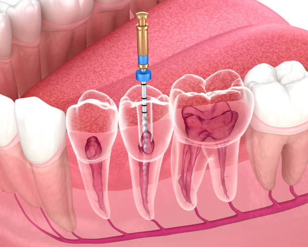 Endodontic root canal treatment process. Medically accurate tooth 3D illustration. stock photo