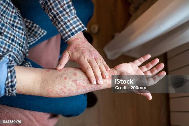 Adult Skin Problem Stock Photo - Download Image Now - Eczema, Psoriasis, Arm
