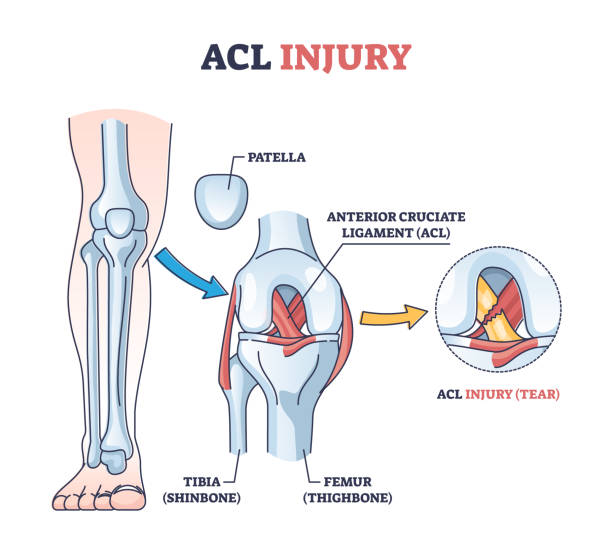 uraz lub uraz acl jako rozdarcie lub skręcenie przedniego zarysu krzyża - cruciate ligament stock illustrations