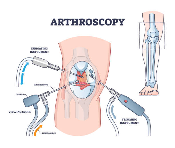 Arthroscopy procedure as knee diagnostics process explanation outline diagram vector art illustration