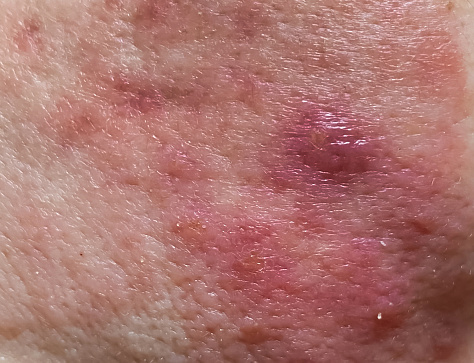 Close-up, selective focus, dermatological infection of the skin, in which redness and rashes on the skin of the face.