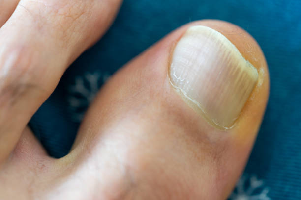 schlecht geschnittener nagel des menschlichen großen zehs auf der linken seite - fungus toenail human foot onychomycosis stock-fotos und bilder
