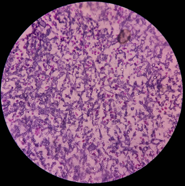 Fungus Infection of Lung, Microscopic image: A Hematoxylin and Eosin stain reveals fungal hyphae of histology tissue block specimen. Fungus Infection of Lung, Microscopic image: A Hematoxylin and Eosin stain reveals fungal hyphae of histology tissue block specimen. animal skin flash stock pictures, royalty-free photos & images