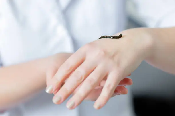 Photo of medicinal leech on the doctor's hand