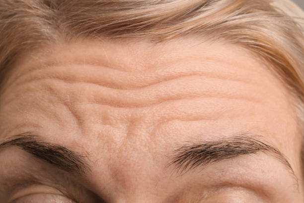 female forehead with wrinkles - skrynklig bildbanksfoton och bilder