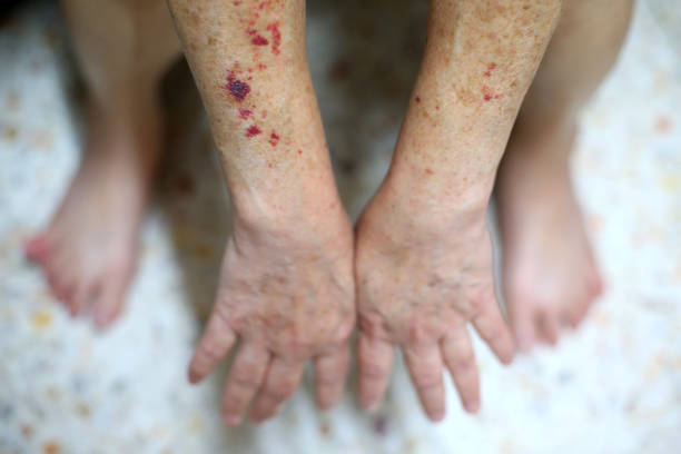 Petri Roccesia Rash Petechiae Rash Stock Photos, Pictures & Royalty-Free Images - iStock