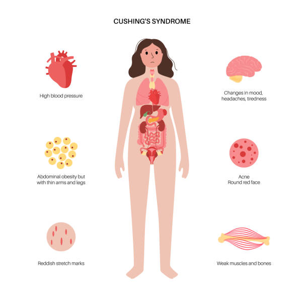 Cushing Desease poster Cushing syndrome disease infographic poster. Cortisol in adrenal gland. Increased secretion of ACTH. Main symptoms, pain and inflammation in the human body. Flat vector isolated medical illustration. Cushing Syndrome stock illustrations