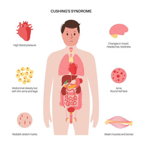 クッシング症候群のストックイラスト素材