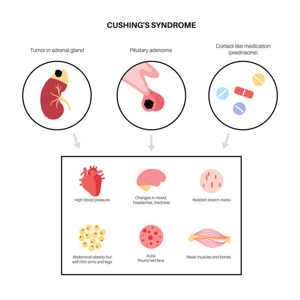 Cushingç 90+ Cushings Syndrome Stock Photos, Pictures & Royalty-Free Images - iStock