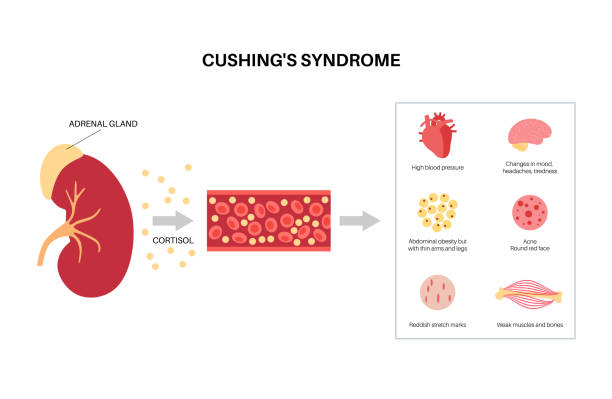 plakat cushing desease - insufficiency stock illustrations