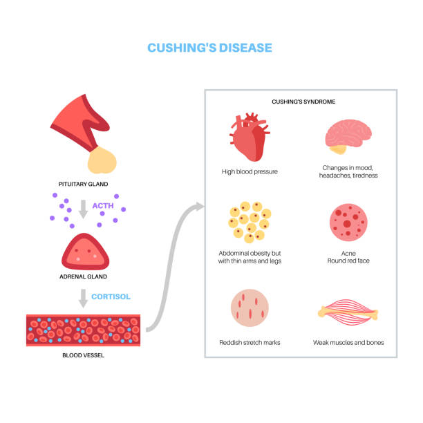 Cushing Example 370+ Cushing Disease Stock Photos, Pictures & Royalty-Free Images - iStock