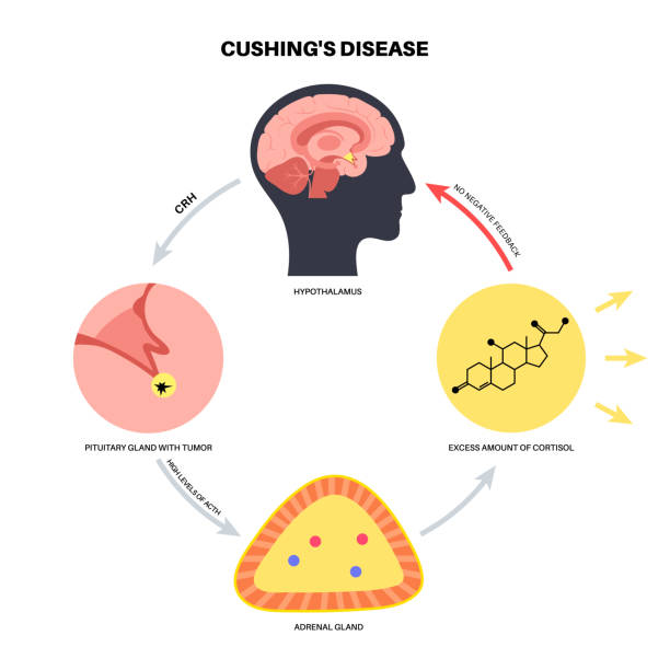 Cushingç 370+ Cushing Disease Stock Photos, Pictures & Royalty-Free Images - iStock