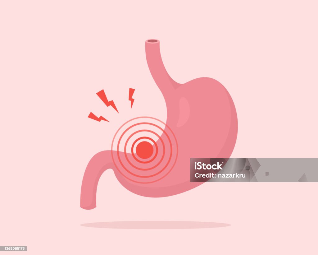 Vatsakipu. Gastriitti, ruoansulatushäiriöt, närästys. Vektorikuva ihmisen sisäisestä elimestä. - Rojaltivapaa avainsanalla Mahalaukku ja tyyppiä kuvapankin vektori Vatsakipu. Gastriitti, ruoansulatushäiriöt, närästys. Vektorikuva ihmisen sisäisestä elimestä. - Rojaltivapaa avainsanalla Mahalaukku ja tyyppiä kuvapankin vektori