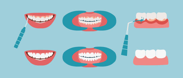 mundhöhle vor und nach der verwendung der wasserbewässerung. - gums stock-grafiken, -clipart, -cartoons und -symbole