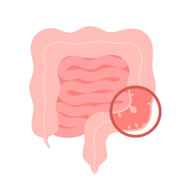 illustrations, cliparts, dessins animés et icônes de coloscopie intestinale, procédure de polypectomie, ablation du polype dans le côlon. bilan de santé intestinale, chirurgie du côlon. opération intestin. illustration vectorielle - côlon