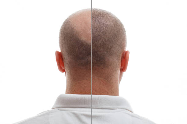 1,041 Hair Implant Stock Photos, Pictures & Royalty-Free Images - iStock | Hair transplant, Hair loss, Hair restoration 1,041 Hair Implant Stock Photos, Pictures & Royalty-Free Images - iStock | Hair transplant, Hair loss, Hair restoration