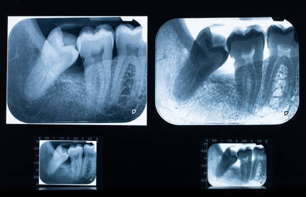 Detailed X-ray scan with impacted wisdom teeth issue